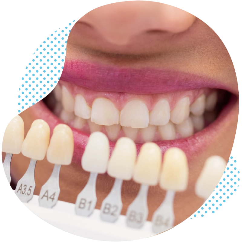 Dental Veneers in Turkey – Beautiful teeth without grinding