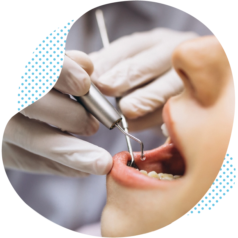 Inlays and Fillings in Turkey