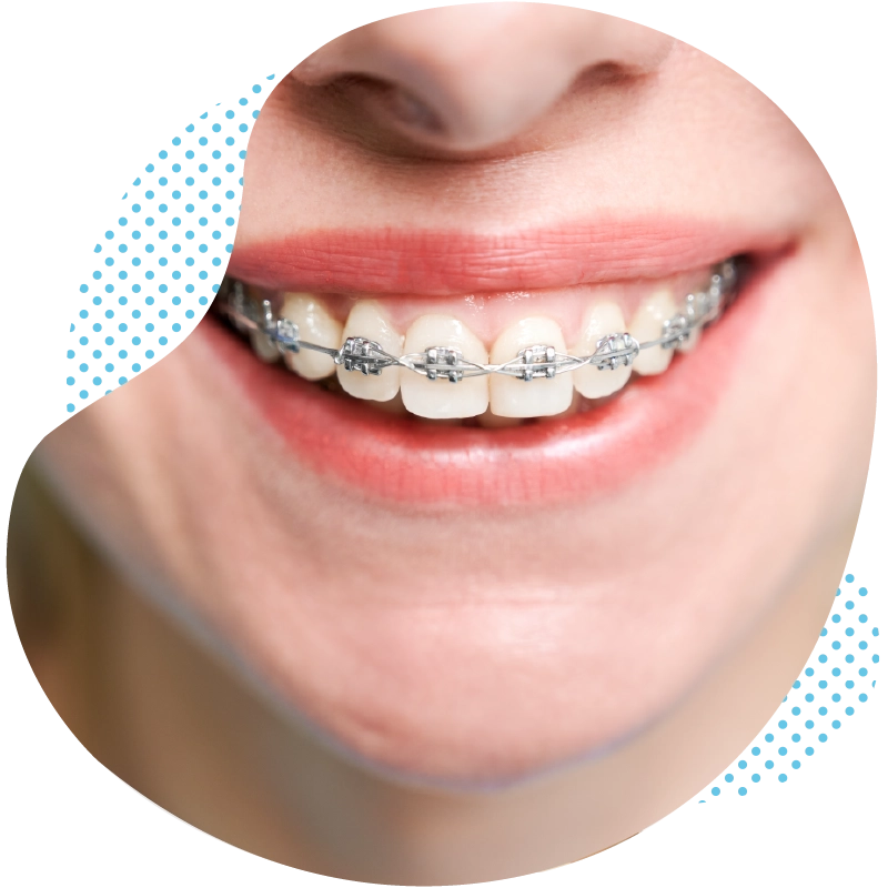 Orthodontia in Turkey General orthodontics for young and old
