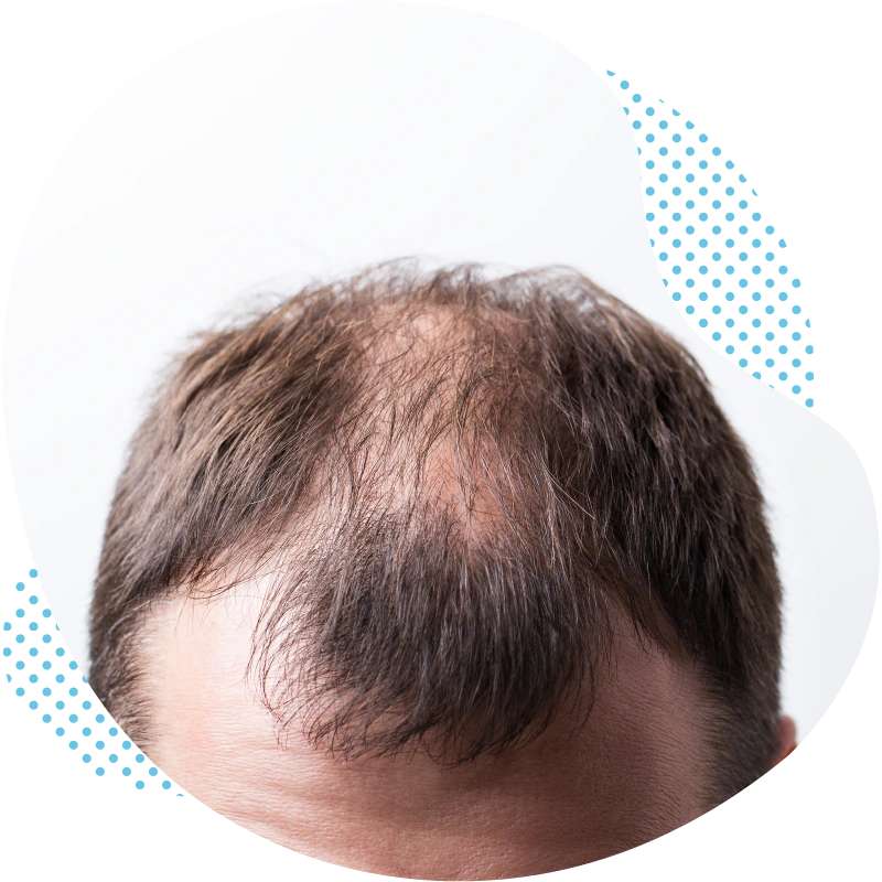 What types of hair loss are there