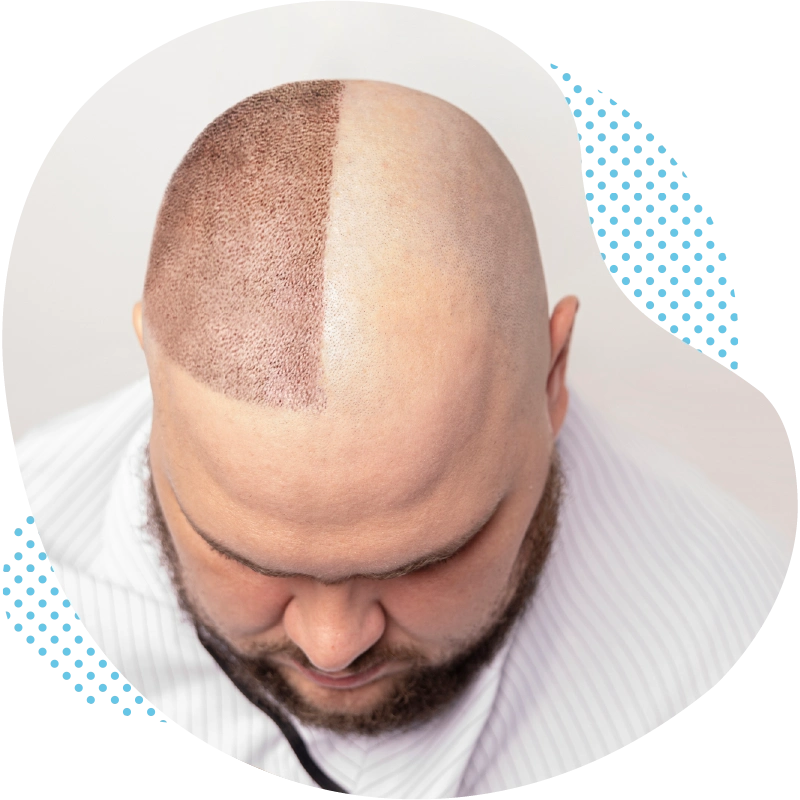 How does the FUE hair transplantation work