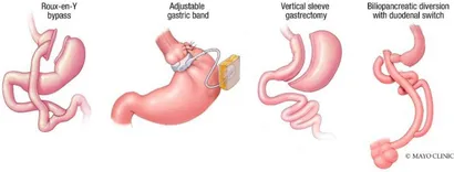 7 Critical Insights into Gastric Sleeve Surgery