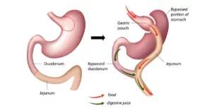 7 Ways Roux-en-Y Gastric Bypass Surgery Can Transform Your Future