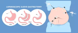 Achieving Lasting Weight Loss with Sleeve Gastrectomy: 7 Things You Need to Know: Sleeve gastrectomy has become one of the most popular and effective types of bariatric surgery