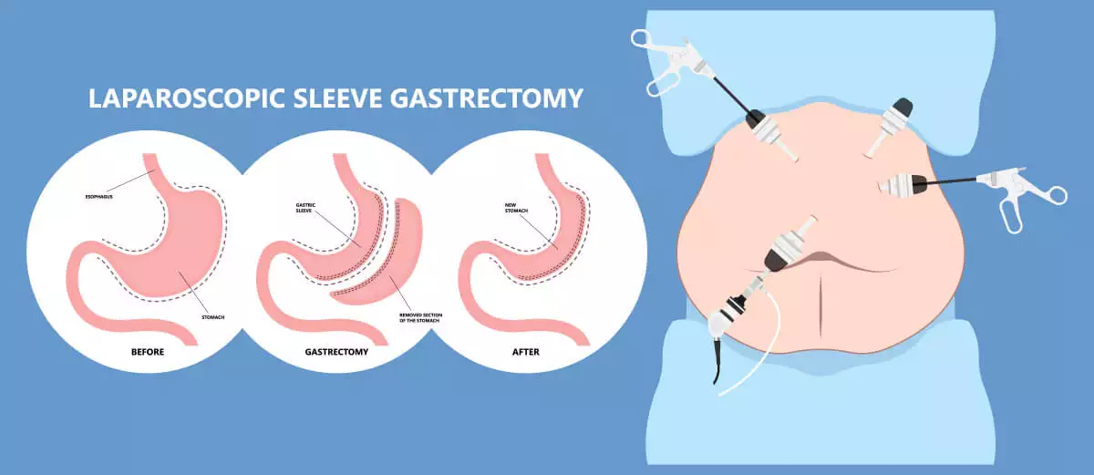 Achieving Lasting Weight Loss with Sleeve Gastrectomy: 7 Things You Need to Know: Sleeve gastrectomy has become one of the most popular and effective types of bariatric surgery