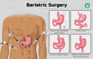 Bariatric Surgeries Turkey at Aesthetic Travel 2024