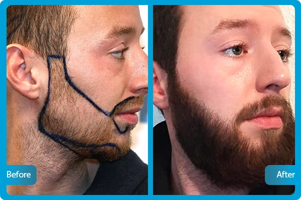 FUE Hair Transplantation Turkey Before After