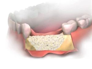 Bone Grafting Recovery: Tips and What to Expect Post-Procedure