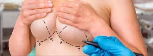 Breast Lift Recovery: Tips and What to Expect Post-Surgery