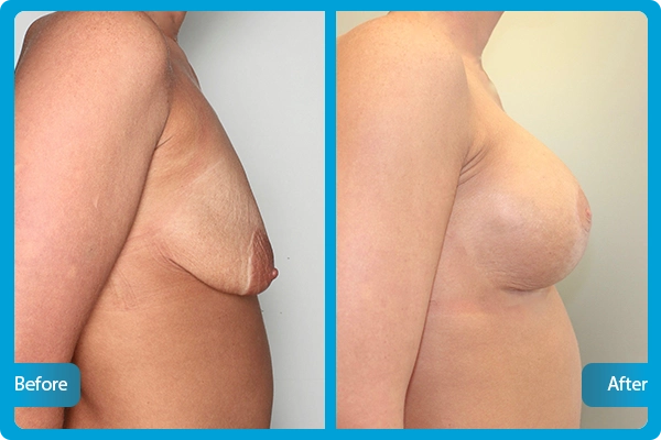 Breast Lift in Turkey Before & After Photos