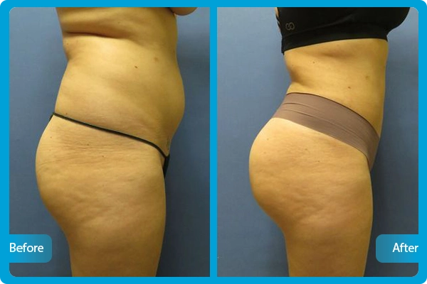Buttock Lift Turkey Before After