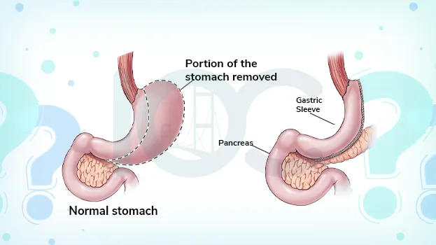 Diabetes Surgery in Turkey: Health Through Bariatric Surgery