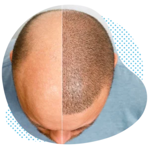 Discover Hair Transplantation Solutions in Turkey with Aesthetic Travel