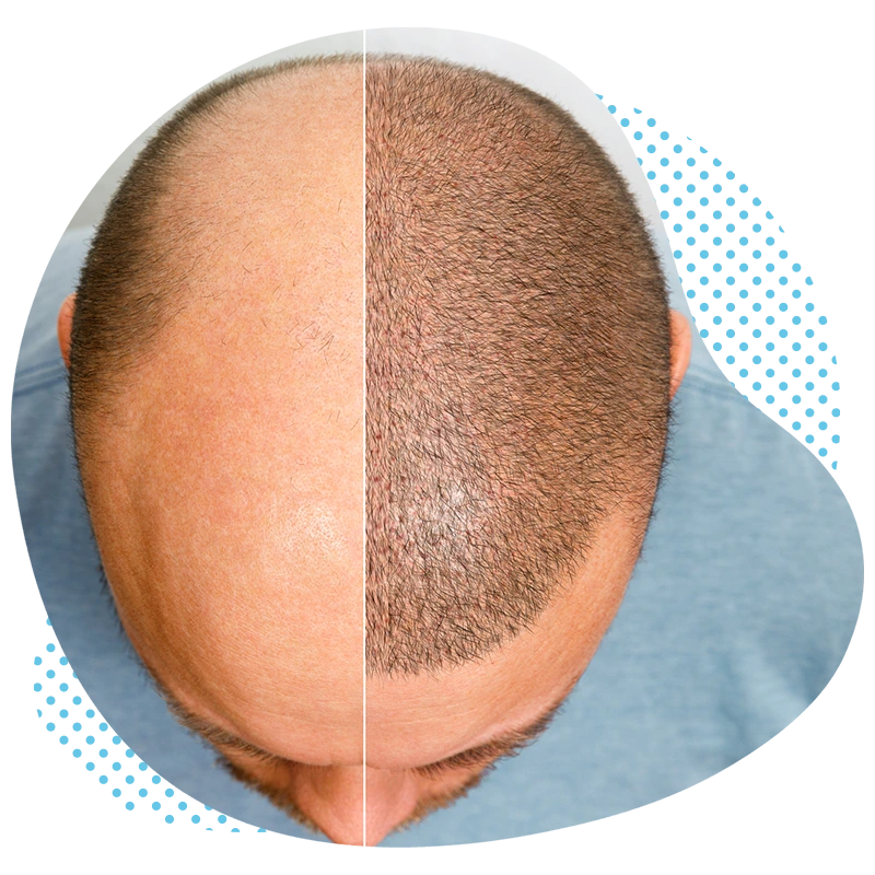 Discover Hair Transplantation Solutions in Turkey with Aesthetic Travel