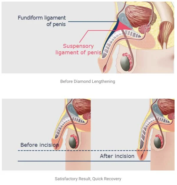 Exploring the Benefits of Penoplasty Surgery: