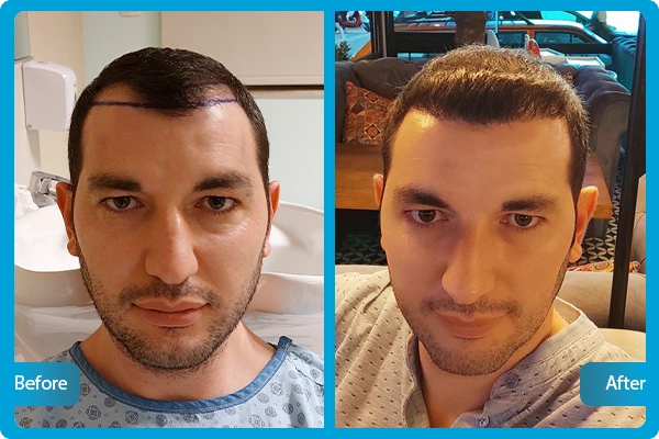 FUE Hair Transplantation Turkey Before After