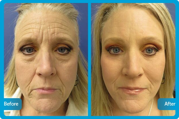 Face Lifting Turkey Before After