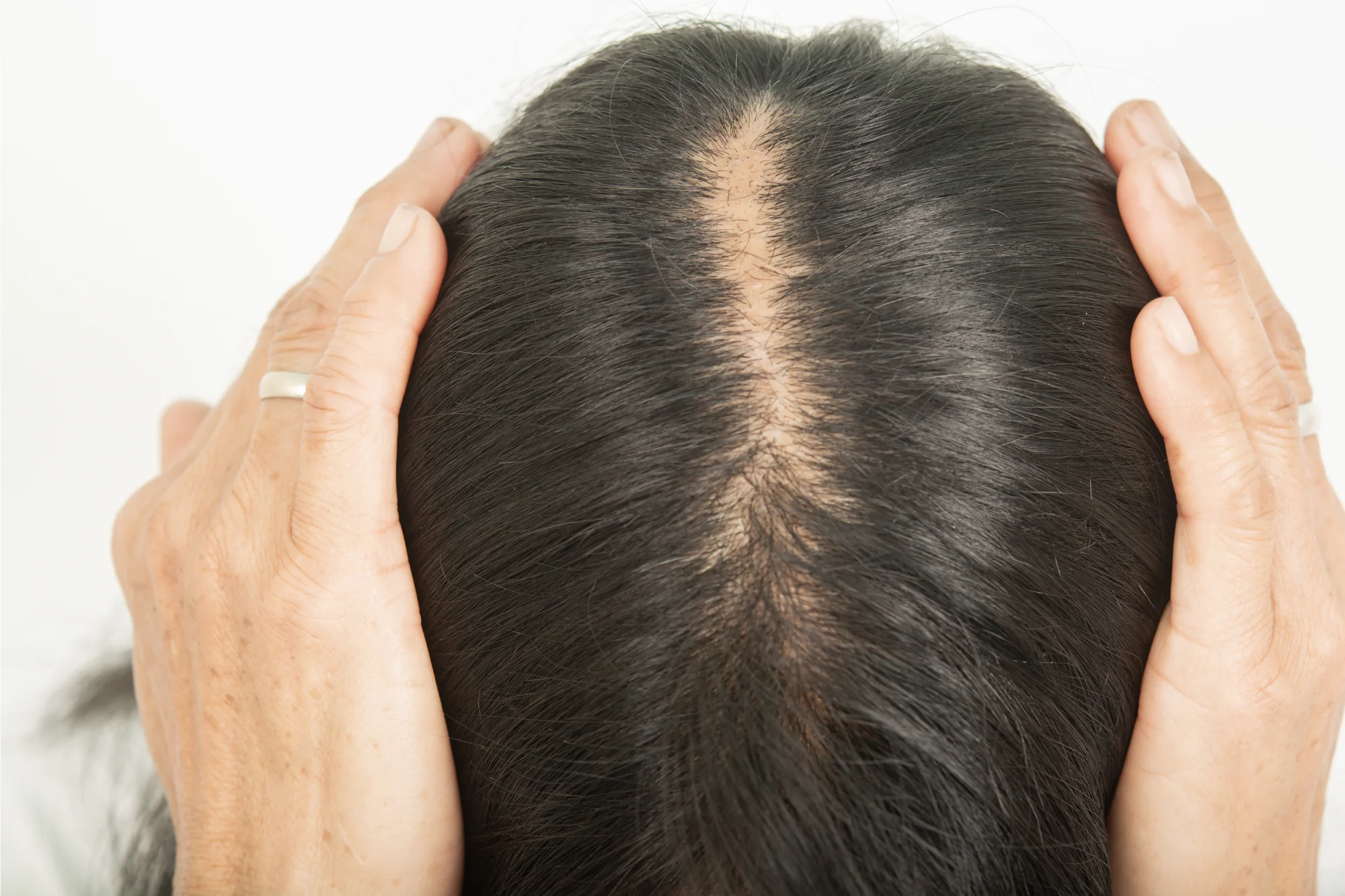 Why Female Pattern Baldness is Different: Specialized Techniques