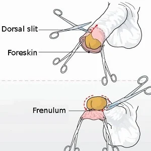 Foreskin Obstacle for Penoplasty