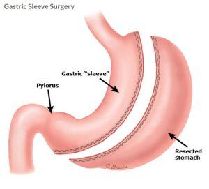 Gastric-sleeve-.-stomach-reduction-surgery-for-weight-loss-in-Turkey-Cost.