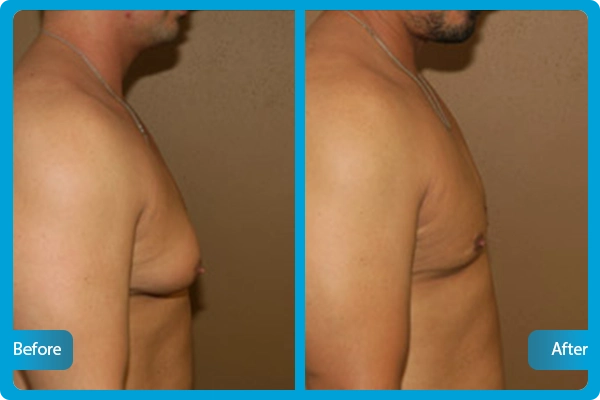 Gynaecomastia Turkey Before After