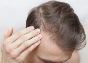 FDA-approved Hair Loss Treatments: What You Need to Know