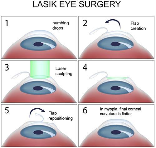 prk Lasik Laser Eye Surgery in Turkey Antalya Costs Eye Lasik Turkey Antalya