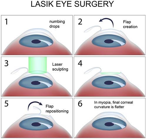 Eye Lasik Turkey Antalya Aesthetic Travel   Laser Eye Surgery In Turkey Antalya 