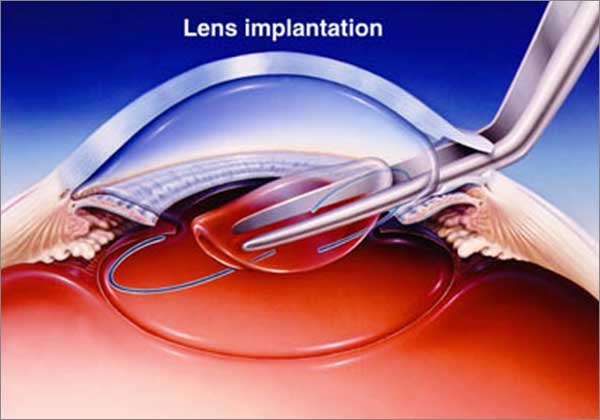 Lens Implantation in Turkey antalya costs Cataracts and Presbyopia