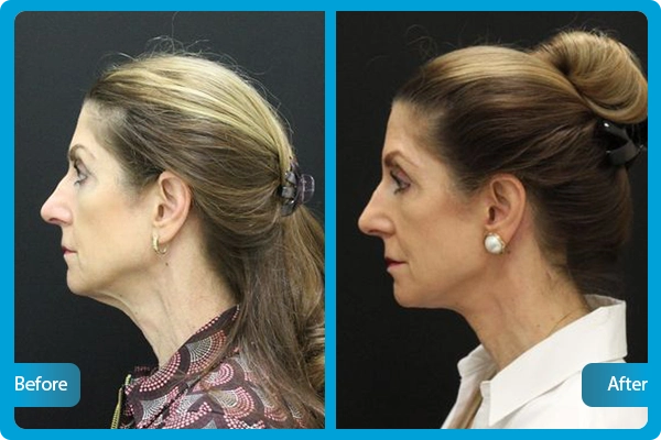 Neck Lift in Turkey Before After