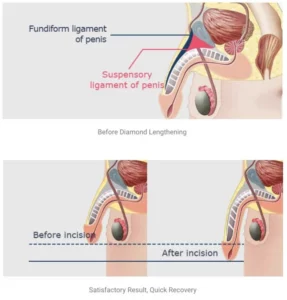 Penoplasty in Turkey: Guide to Penis Enlargement Cost, Procedure