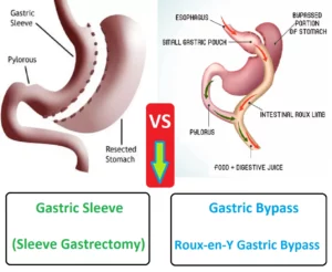 Sleeve Gastrectomy vs. Gastric Bypass: What's the Difference?