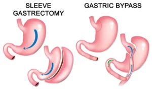 Surgical Treatment of Type 2 Diabetes