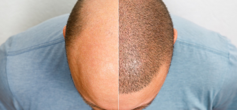 The Rise of Hair Transplant Tourism
