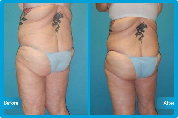 Thigh Lift in Turkey Before After