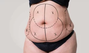 Tummy Tuck Recovery: What to Expect