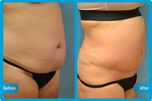 Tummy Tuck Turkey Before After