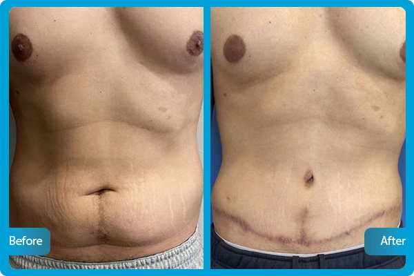 Tummy Tuck Turkey Before After