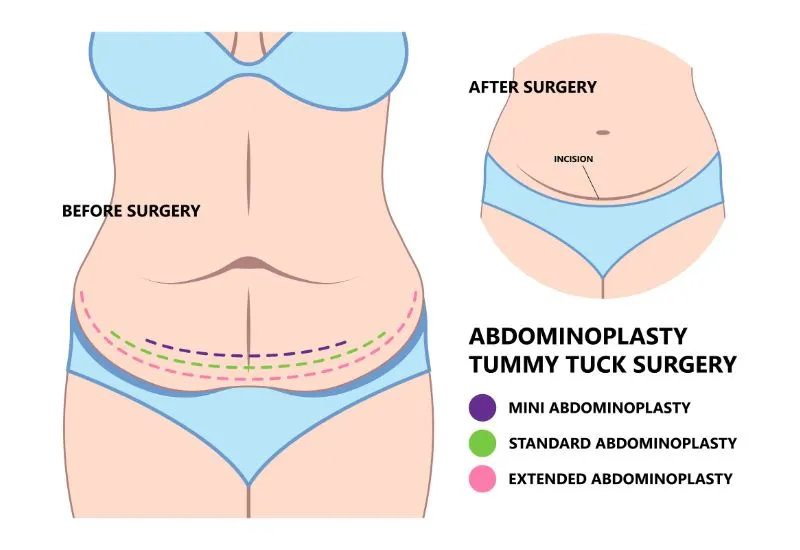 Understanding Abdominoplasty: A Comprehensive Guide