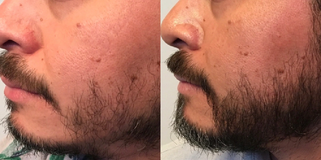 Beard Transplant Turkey Before After