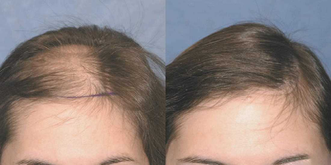 Hair Transplant for Women Turkey Before After