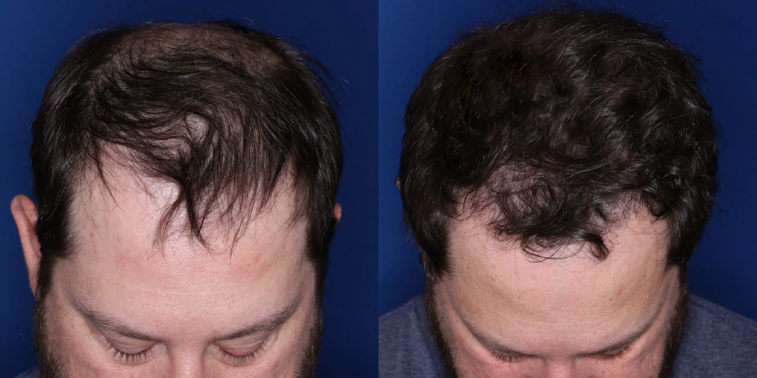 DHI Hair Transplant Turkey / Antalya Before After