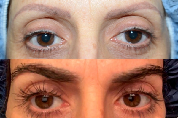 Eyebrow Transplantation Turkey