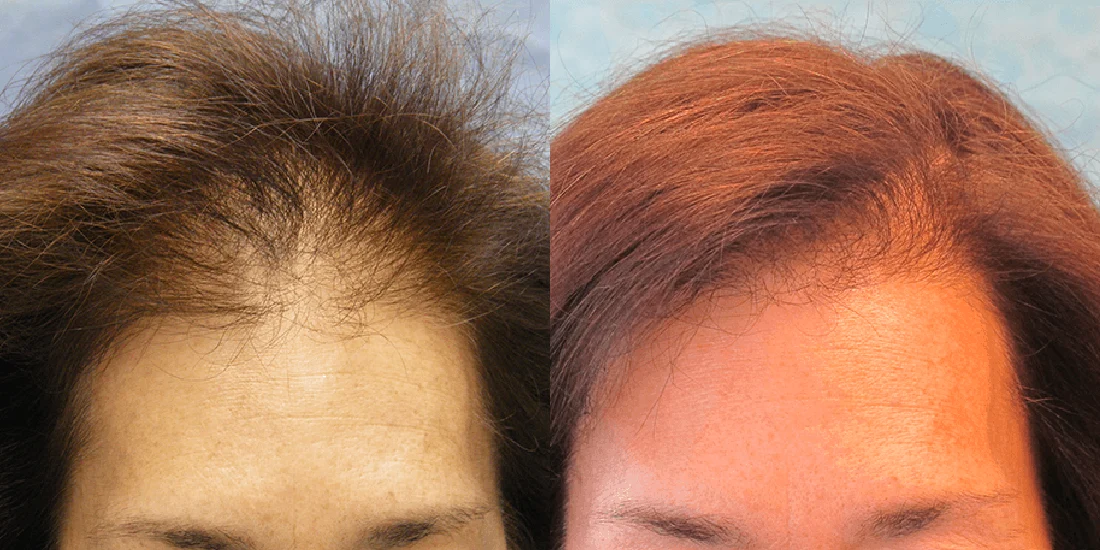 Hair Transplant for Women Turkey Before After
