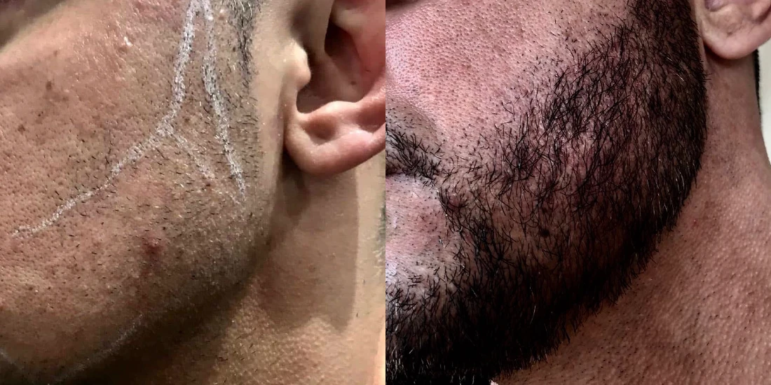 Beard Transplant Turkey Before After