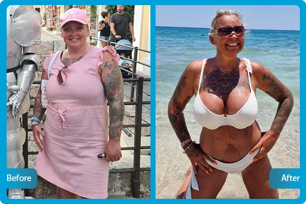 gastric-sleeve-before-after