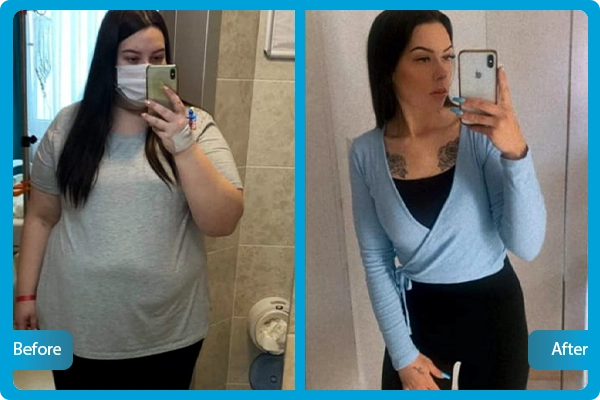 gastric-sleeve-before-after